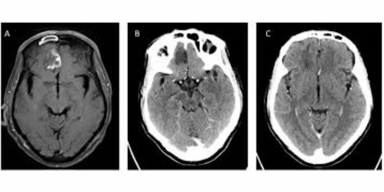 Mucormycosis or Black Fungus - JournalsOfIndia